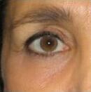 Peeling faciales - Cirugía oculoplástica