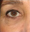 Peelings faciales - Ácido tricloroacético - Cirugía oculoplástica