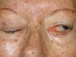 Parálisis facial - Cirugía oculoplástica