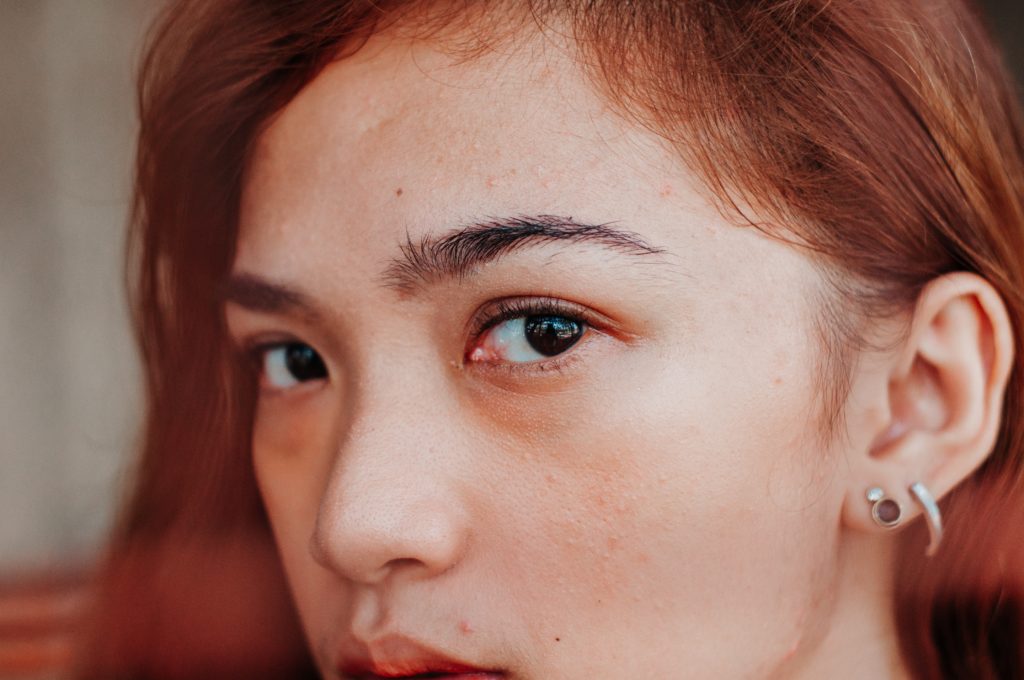 Trata las cejas y párpados caídos para eliminar la piel sobrante y rejuvenecer tu rostro sin alterar la expresión.