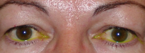 Elimina la piel caída de tus párpados con la blefaroplastia superior de forma natural y segura.